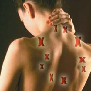 TRIGGER POINT: cosa sono?
